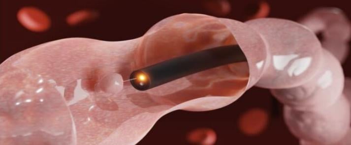 منظار القولون.. هل يعد اختبارًا روتينيًا؟ 