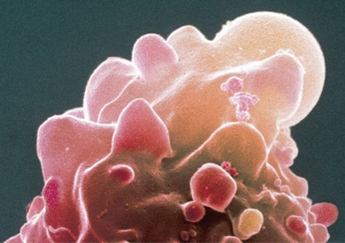يمكن أن تؤدي الخلايا السرطانية في نسيج الأمعاء إلى أعراض يمكن اكتشافها عن طريق برنامج الفحص