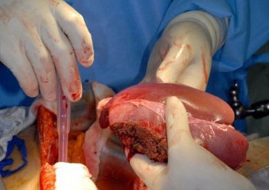 تجارة الاعضاء البشرية - ارشيفية