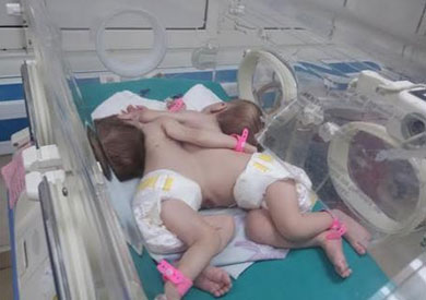 مستشفى الأطفال التخصصي ببنها يستقبل توأم ملتصق من الصدر والبطن