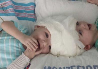 تمثل حالة التؤأم حالة نادرة تحدث مرة واحدة بين كل 10 ملايين حالة ولادة