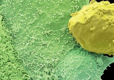 سرطان البروستاتا هو الأكثر شيوعا بين الرجال